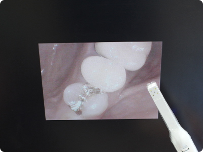 小林歯科医院の口腔内カメラ