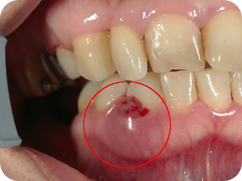 歯周基本治療前