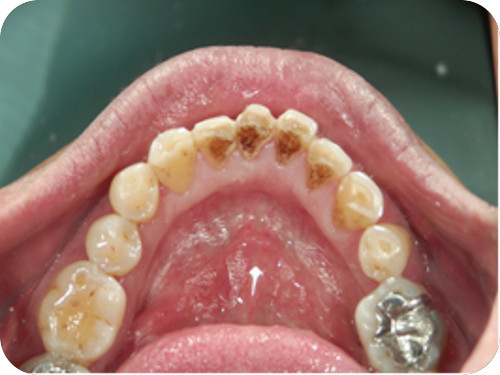 予防歯科処置前　タバコ・ヤ二の除去