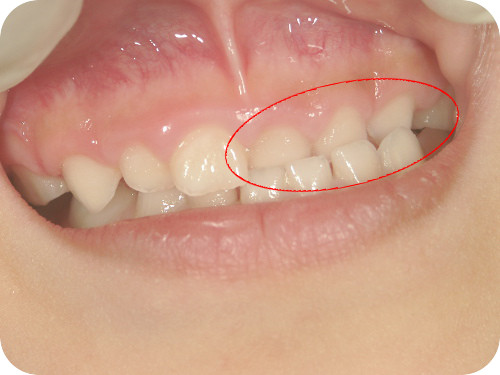 左上前歯の反対咬合　治療前
