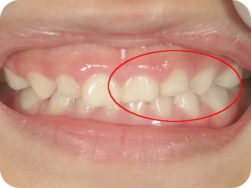 左上前歯の反対咬合　治療後
